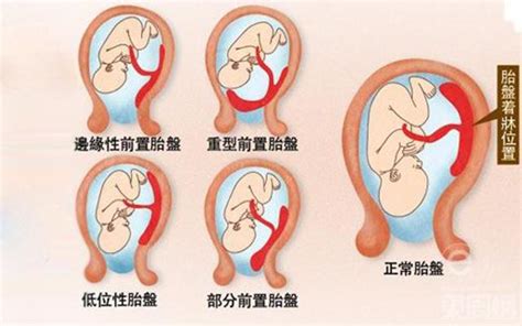 胎盤位置會變嗎